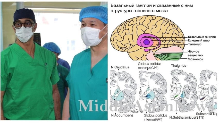 Третья государственная центральная больница вводит операцию по удалению глубоко расположенных опухолей мозга