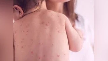 Общее число подтвержденных случаев кори достигло 13 171