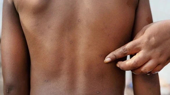 С начала 2025 года в странах Африки зарегистрировано 32 тыс. случаев оспы обезьян