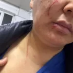 Конфликт в Кара-Жыгаче: Женщина из видео рассказала свою версию, показала ушибы и раны