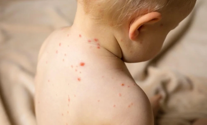 С июня в Кыргызстане меньше случаев кори, но врачи напоминают о вакцинации