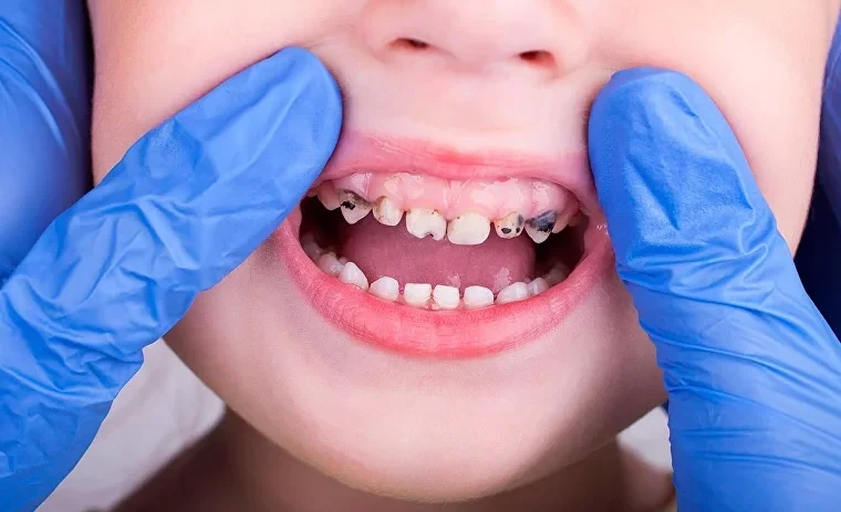 В Кыргызстане почти 95% детей страдают кариесом – стоматолог назвала опасные осложнения