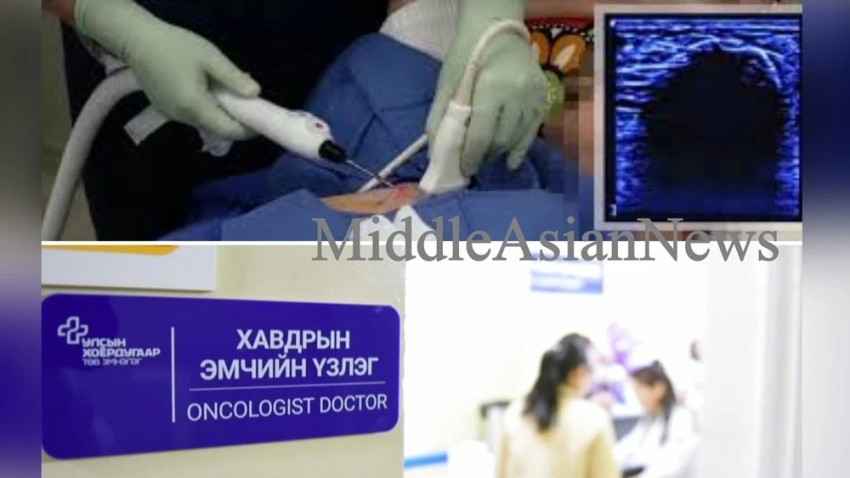 Монгольские онкологи начали применять новый метод замораживания опухолей