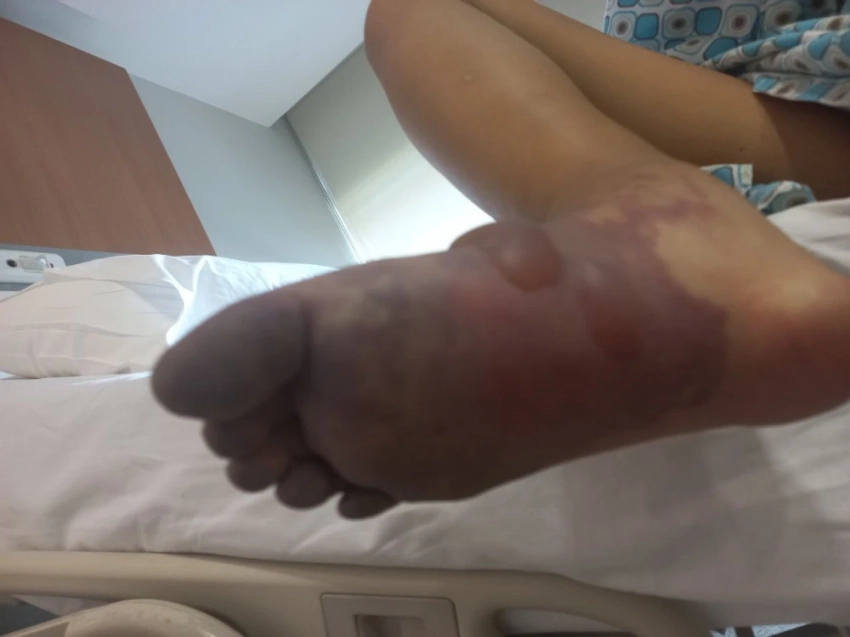 Девочка-подросток осталась без ноги. Ее мама винит врачей (фото, видео)