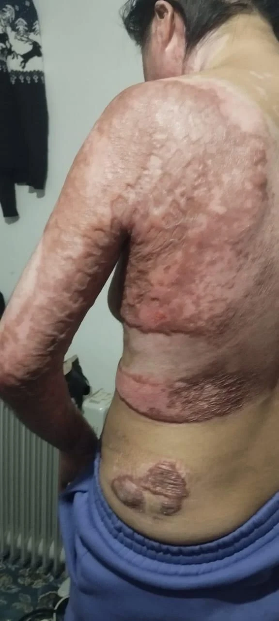 В Таласе мужчина облил бензином и поджег супругу. Осторожно, фото