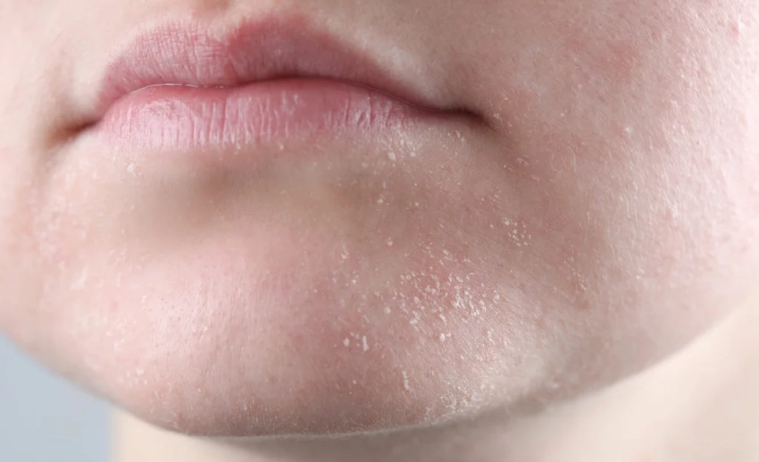 Врач рассказала о связанных с сухостью кожи болезнях